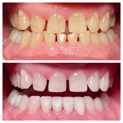 Before and After with lower front crowns and whitening!