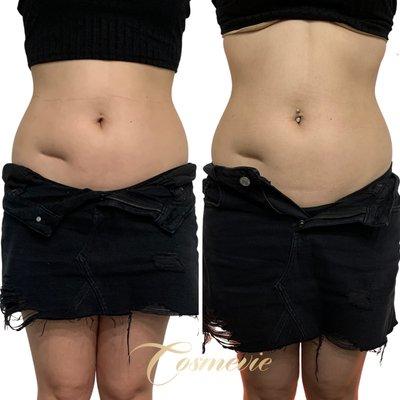 Body Sculpting with Lipo Cavitation, Wood Therapy and Heat Therapy