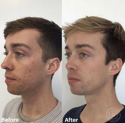 Before and after, just a few months into my acne treatments with Dr. Campbell