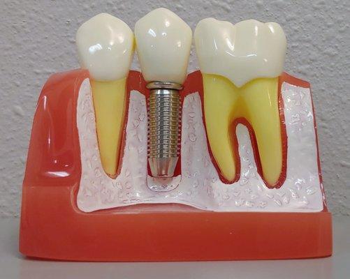 Dental implant model