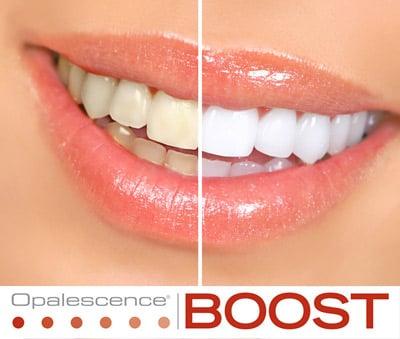 CALL ABOUT SPECIAL PRICING ON OUR IN OFFICE WHITENING PRODUCTS!