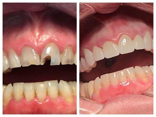 Dr. Wells does incredible restorative work with crowns!