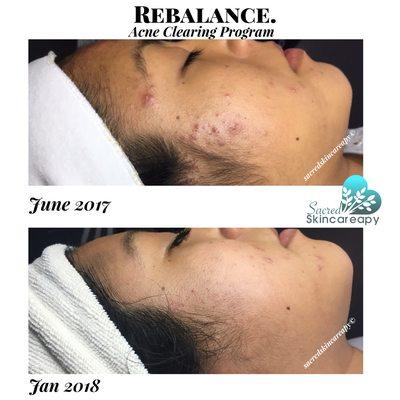 Another successful client achieves clear skin! I love helping my clients get clear.