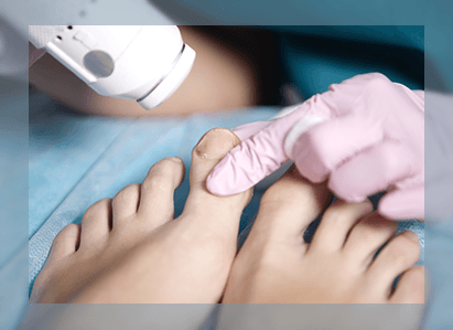 Laser treatment for Nail Fungus