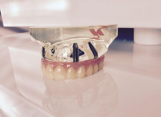 Model of full reconstruction with implant supported fixed bridge which can be completed in one visit.