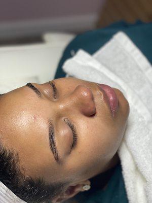 Microdermabrasion treatment