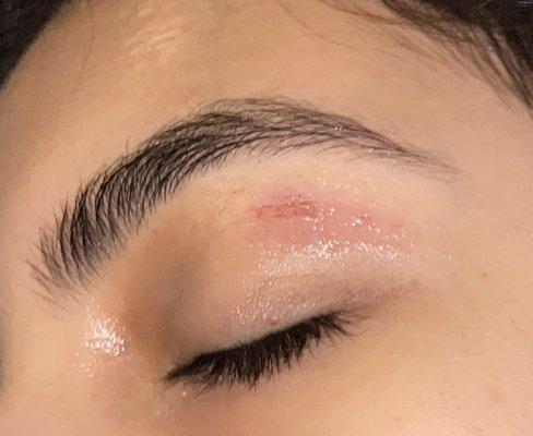 Burn from eyebrow wax