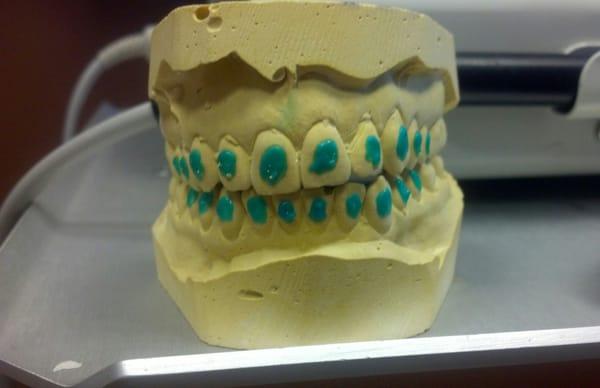 A mold of my teeth (for whitening trays)