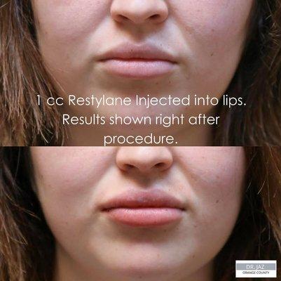 Our patient had 1 cc Restylane injected into her lips. Result is right after the procedure.