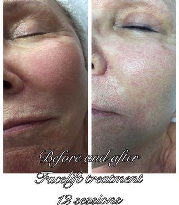 Micro current face lift before and after