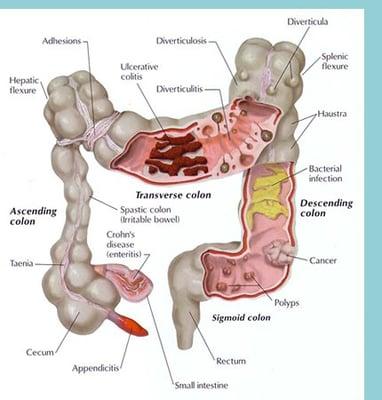 ColonicS Los Angeles, Colonics help with constipation, clears up skin and helps with weight loss, lose inches off your belly instantly