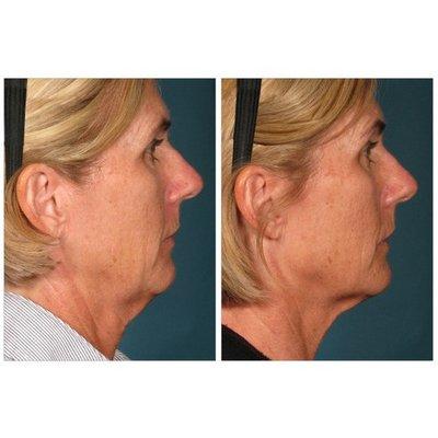 Ultherapy Before & After Picture