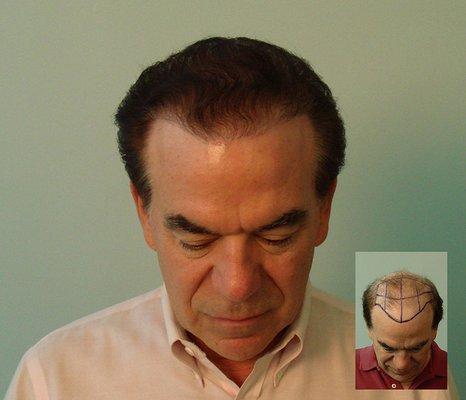 Natural Hair Transplant Medical Center