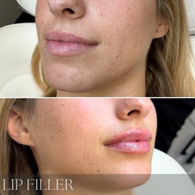 Lip Filler in Phoenixville PA at Nakd Aesthetics