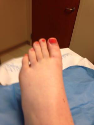 Julia having ingrown toenail removed:(