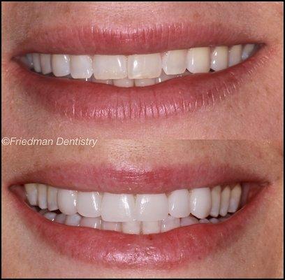 Dr. Matt Friedman placed 6 ceramic veneers to restore proper length and shape to this patients worn natural dentition.