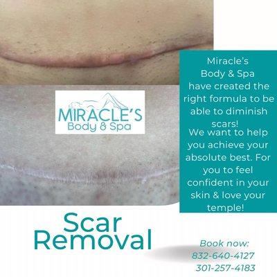 Keloid Scar treatment