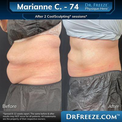 Marianne after 2 CoolSculpting sessions!