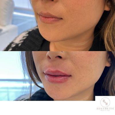 Gorgeous lips with 1/2 syringe filler