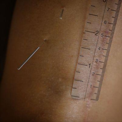 Acupuncture is a scientifically supported medical procedure.