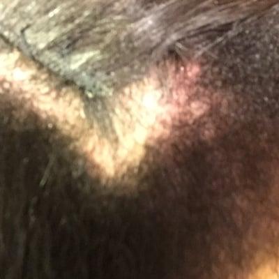 My obviously inflamed scalp. After 12 days. She offered no help!