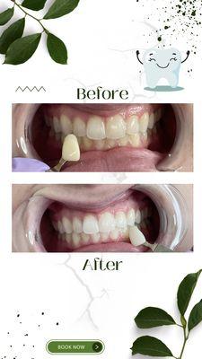 Professional teeth whitening, same days results. Pain free