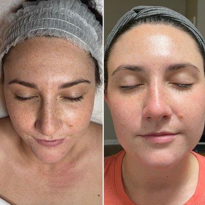 See the difference facial with add on microdermabrasion