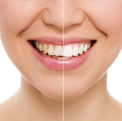 Laser Teeth Whitening