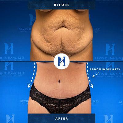 Tummy tuck also known as abdominoplasty is a cosmetic surgical procedure to improve the shape and appearance of the abdomen.