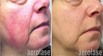 Rosacea treatment