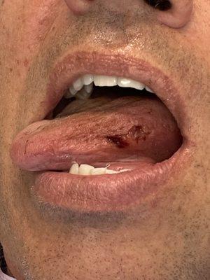 tongue damage from dentist