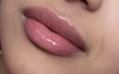 Pucker up with confidence! Enhance your lips with our Hyaluron lip filler for natural-looking volume and a perfect pout.  #LipGoals