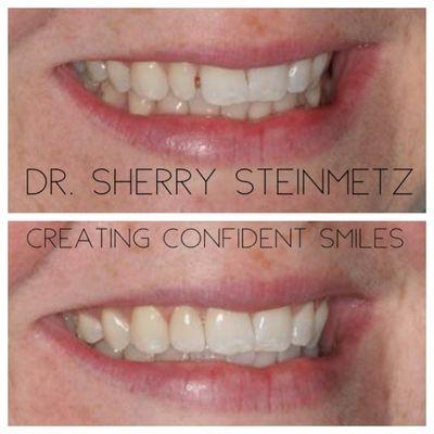 One single veneer by Dr. Sherry Steinmetz