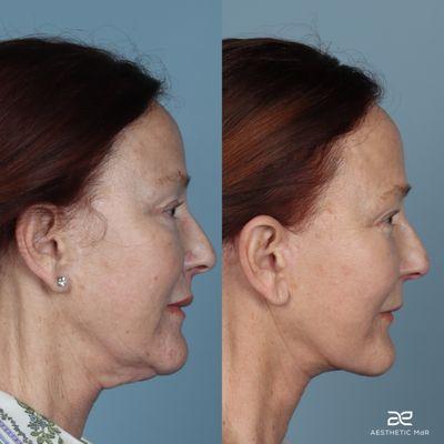 Secondary Deep plane facelift, SMAS lip graft, fat grafting to mid face