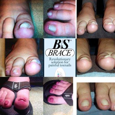 The BS Brace can correct ingrown toenails without surgery.  Gina is the ONLY footcare specialist that offers this service in Seattle.