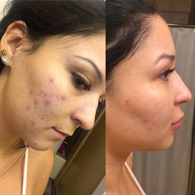 Before treatment and After pic! Acne has cleared up so much with antibiotics and topical creams. PA Mike is great!