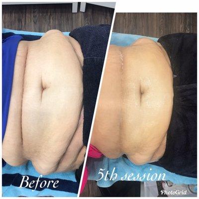 Fat cavitation- cavitation lipo