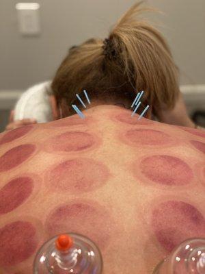 Acupuncture and cupping