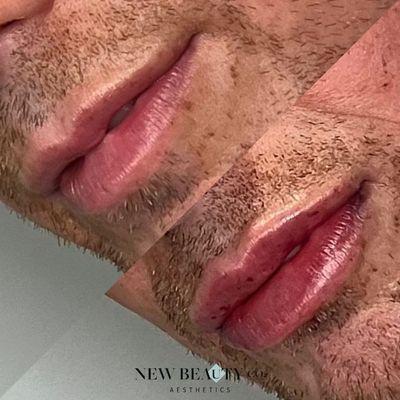 Before and After Lip Filler