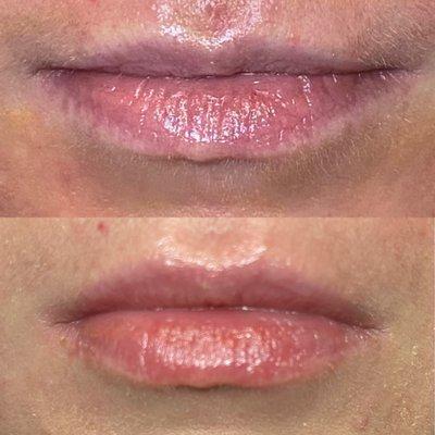 Lip filler by Nichole