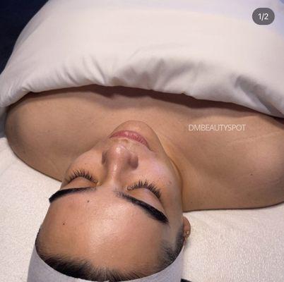 Dermaplane facial