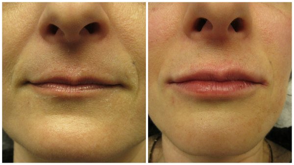 Lips and Naso-labial folds (NLF) before and after.