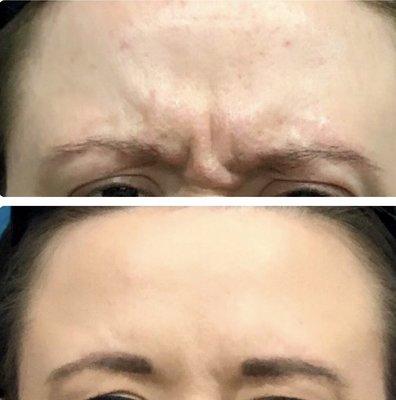 Botox before And after