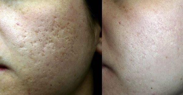 This collagen rejuvenation which improved her cystic acne scars was done with the Sublative Machine. We used the 64 pin hand piece.