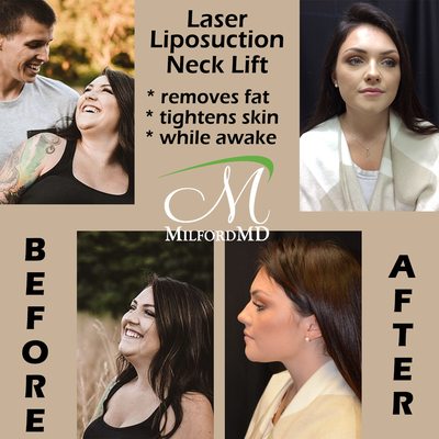 Before & after photos of a laser liposuction neck lift procedure 10 months post-op