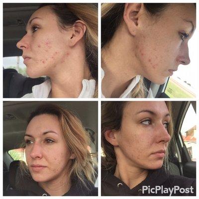 Before & after of my 1st microderm treatment followed by a radio frequency treatment that zapped blemishes & closes your pores.