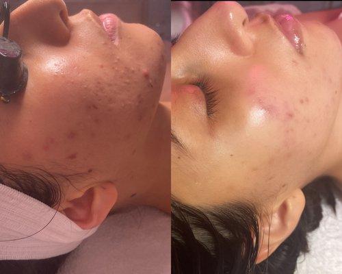 Acne boot camp before and after