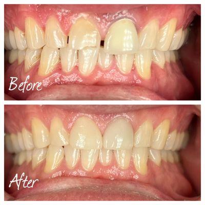 Diastema closure with 2 crowns