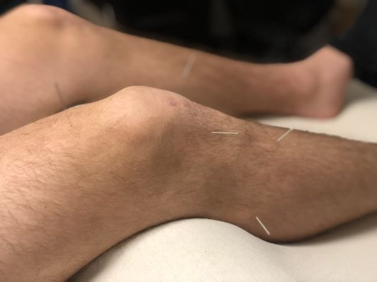 Acupuncture for knee pain