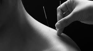 Acupuncture